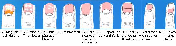 33 Möglich bei Malaria - 34 Embolie, Thrombose - 35 Harnsäurebelastung - 36 Wurmbefall - 37 Herzneurose, Nervenschwäche - 38 Disposition zu Herzinfarkt - 39 Überstandene Krankheit - 40 Vererbtes organisches Leiden - 41 Rückenmarksleiden